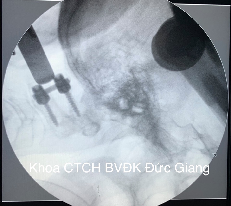 Bệnh viện đa khoa Đức Giang phẫu thuật thành công ca bệnh gãy mỏm nha đốt sống cổ nguy hiểm hiếm gặp