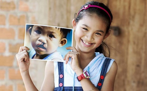 Operation Smile Vietnam rendra le sourire à 200 enfants en mars