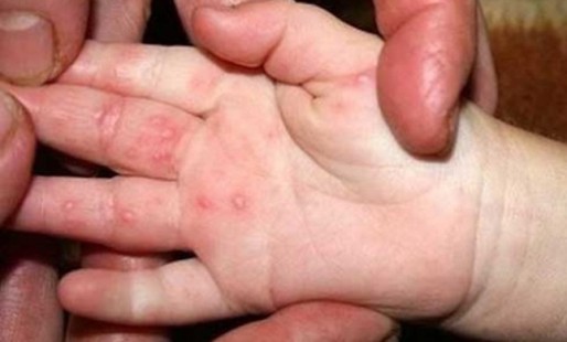 Bộ Y tế Thực hiện ngay 3 sạch để phòng chống bệnh tay chân miệng