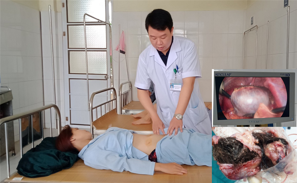 Trung tâm Y tế Hòa An Phẫu thuật nội soi thành công ca bệnh u quái buồng trứng và viêm ruột thừa cấp