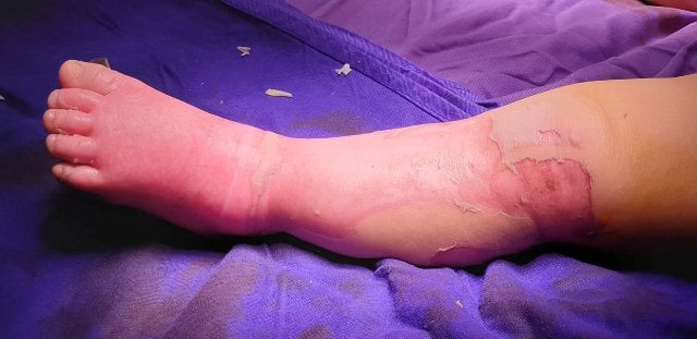 Cảnh báo biến chứng do đắp lá chữa bỏng cho trẻ