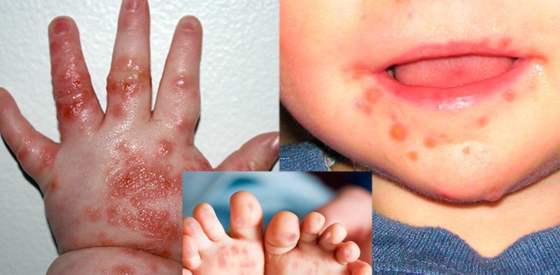 Số ca mắc tay chân miệng tăng 4 lần, Bộ Y tế đề nghị tăng cường phòng chống