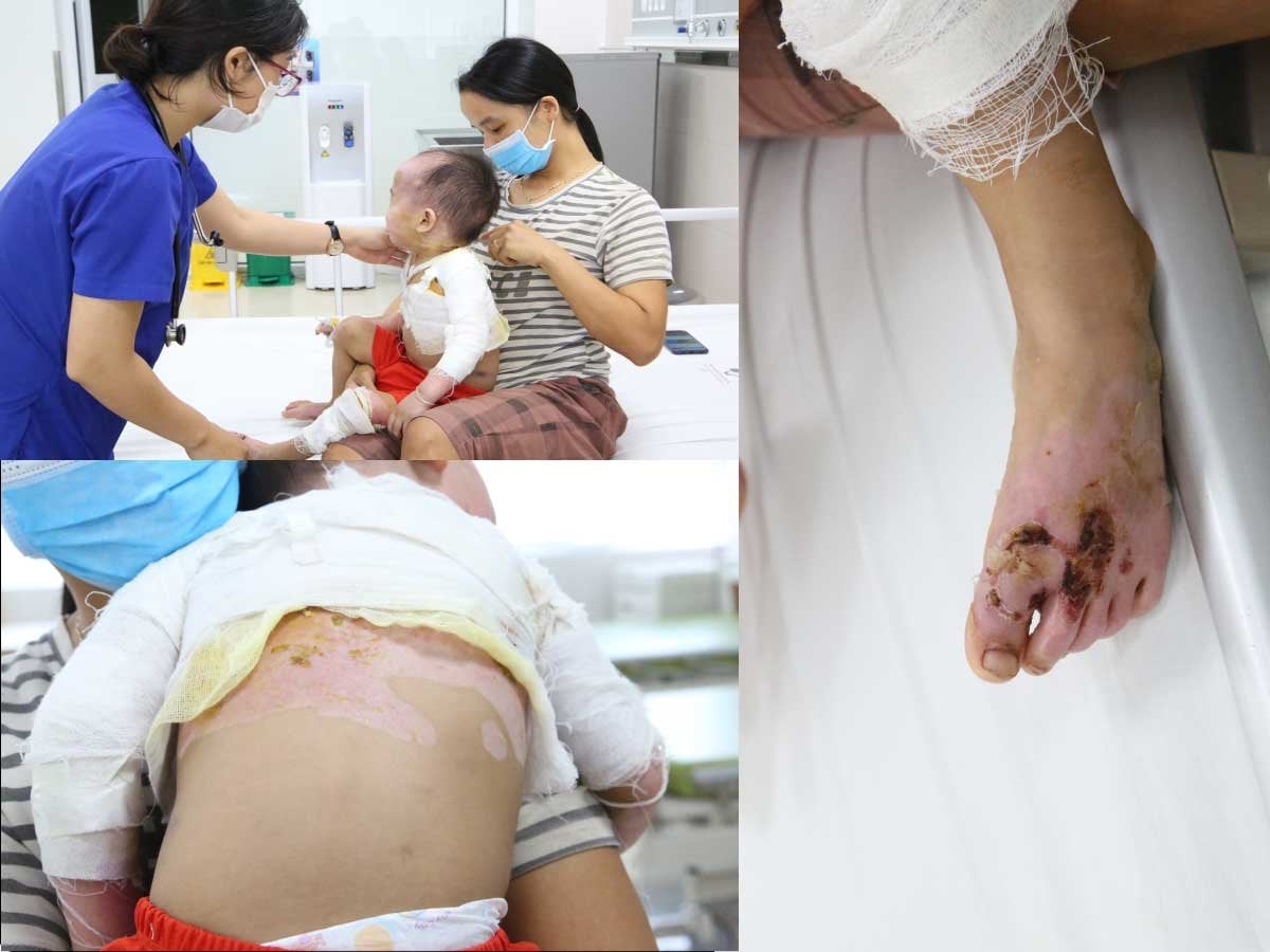 Cảnh báo gia tăng tai nạn thương tích ở trẻ