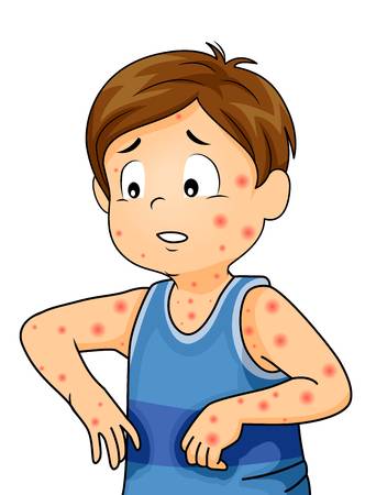 Bạn biết gì về bệnh đậu mùa khỉ