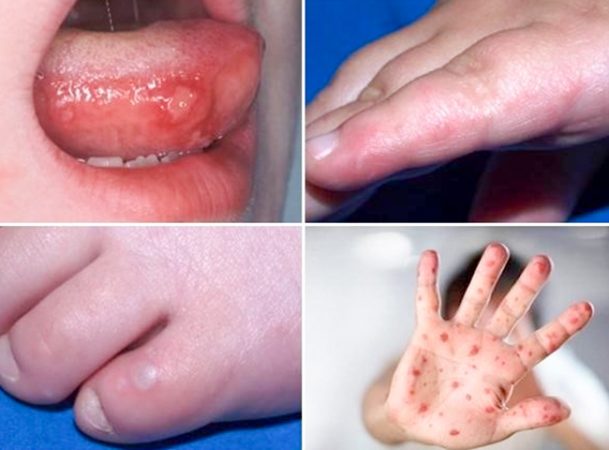Triệu chứng sớm báo hiệu bệnh tay chân miệng trở nặng, cha mẹ cần lưu ý