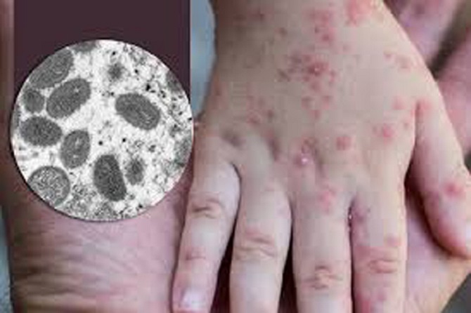 Xuất hiện ca đậu mùa khỉ đầu tiên ở Việt Nam