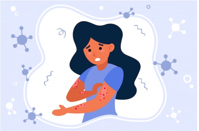 Khuyến cáo phòng chống bệnh đậu mùa khỉ với khách nhập cảnh Việt Nam - Bài 3