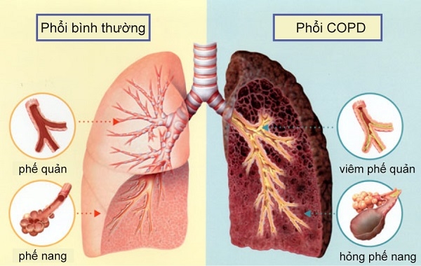 Hút thuốc lá là mối nguy hiểm gây bệnh phổi tắc nghẽn mãn tính