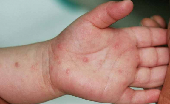 Đã có nguồn cung thuốc điều trị bệnh tay chân miệng về Việt Nam