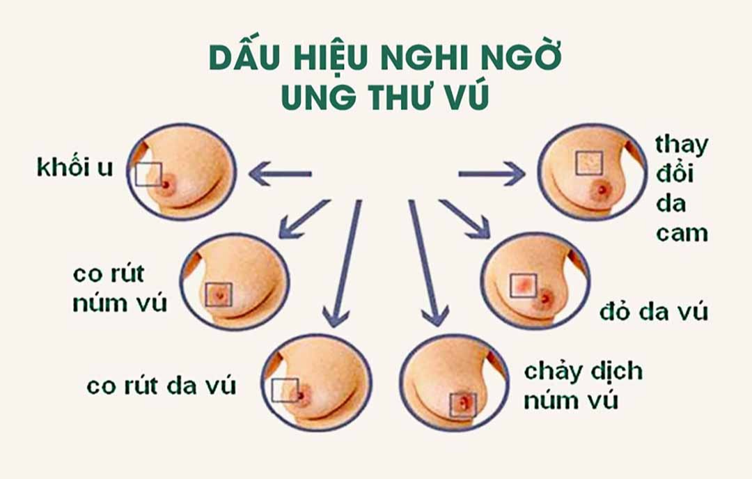 Ung thư vú có thể được chữa khỏi nếu phát hiện sớm