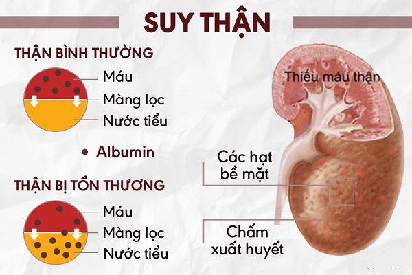 Tầm quan trọng của chẩn đoán và can thiệp sớm bệnh thận mạn