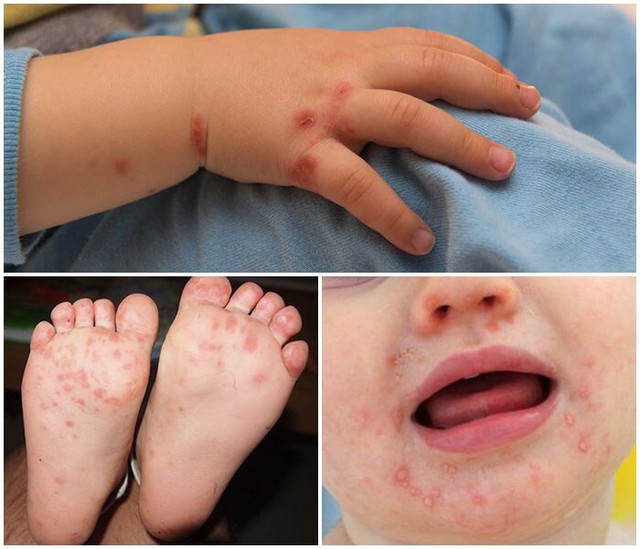 Hà Nội Số ca mắc tay chân miệng tăng mạnh