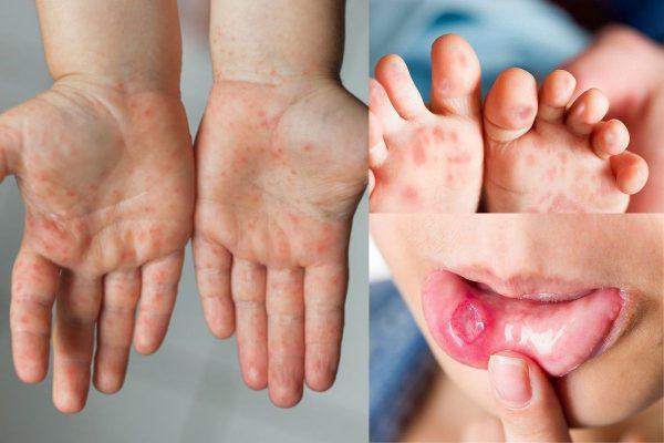 Hà Nội Xuất hiện ổ dịch tay chân miệng tại trường mầm non