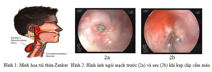 Bệnh viện Nhân Dân 115 Can thiệp cầm máu qua nội soi thành công một trường hợp hiếm gặp
