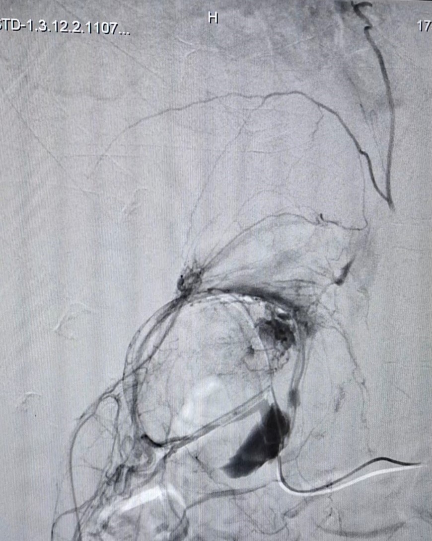 Bệnh viện Quân y 175 Điều trị thành công cho bệnh nhân bị u cơ mỡ mạch thận có xuất huyết trong u
