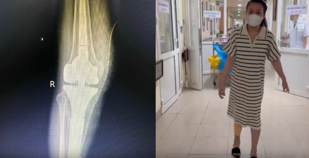 Giữ lại đôi chân cho cô gái mắc u tế bào khổng lồ xương