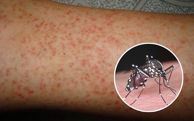 Hà Nội Số ca mắc sốt xuất huyết giảm nhẹ