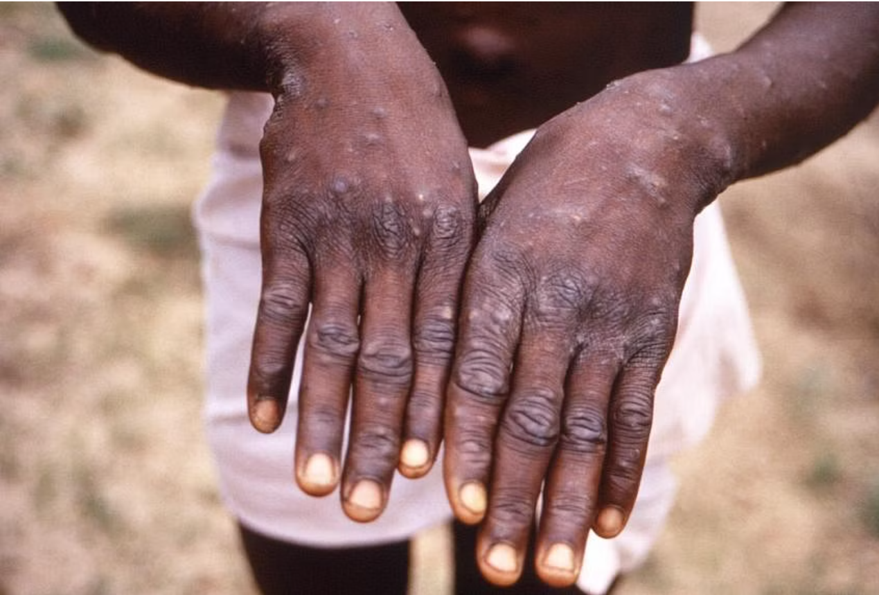 Thế giới ghi nhận gần 92 000 ca mắc bệnh đậu mùa khỉ trong 2 năm qua