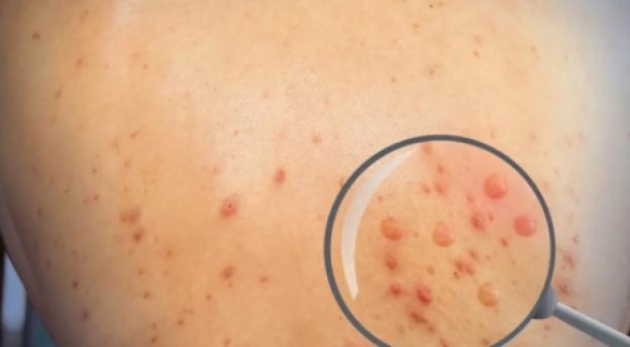 Tiền Giang ghi nhận ca mắc bệnh Đậu mùa khỉ đầu tiên