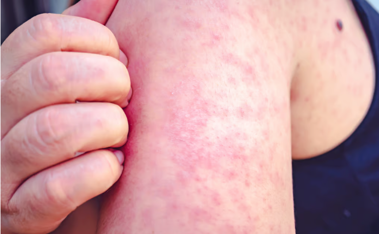 Số ca mắc bệnh sởi tại châu Âu tăng mạnh trong năm 2023