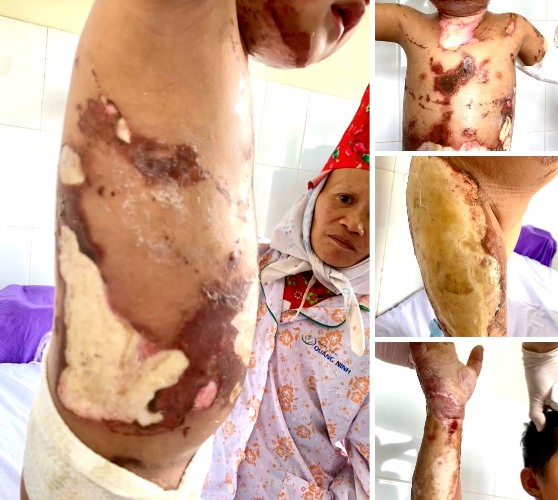 Quảng Ninh Cấp cứu bệnh nhi 3 tuổi bị bỏng nhiệt do lửa cháy