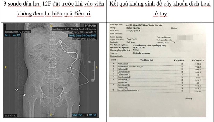 Lần đầu thực hiện thành công nội soi lấy tổ chức tụy hoại tử qua da