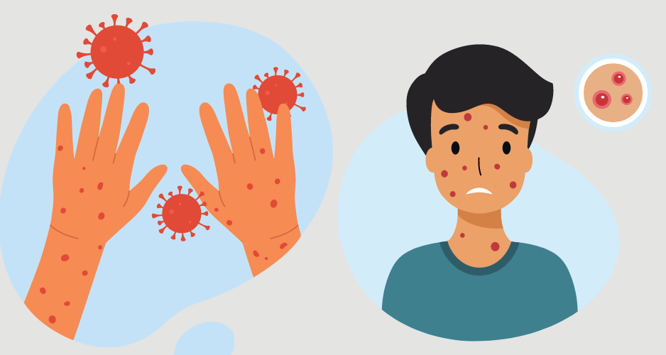 Kiên Giang ghi nhận 3 trường hợp mắc bệnh đậu mùa khỉ