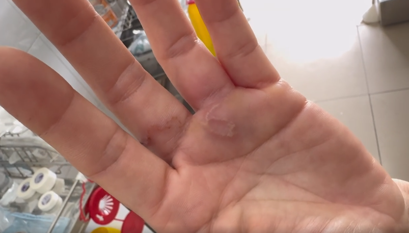 Nuôi 8 con chó mèo, người phụ nữ bị nhiễm ký sinh trùng