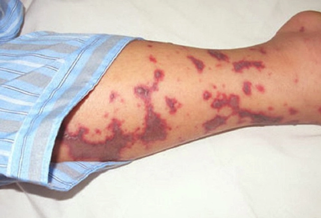 TP Hồ Chí Minh Ghi nhận 1 trường hợp tử vong do não mô cầu