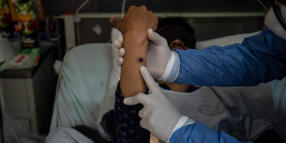 Variole du singe études en cours sur ses mutations génétiques