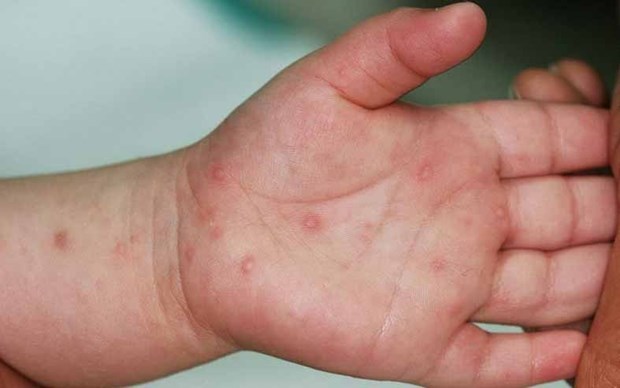 Les hôpitaux s’approvisionnent en médicaments contre la HFMD