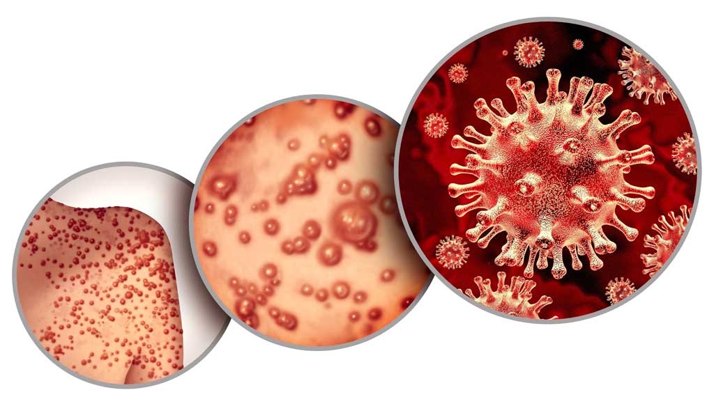 新加坡发现首例本土确诊猴痘病例